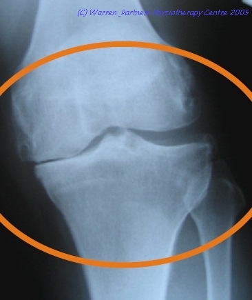 本頁圖片/檔案 - 2009_3_topic_xray_knee
