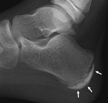本頁圖片/檔案 - 450px-Calcaneal_apohysisitis