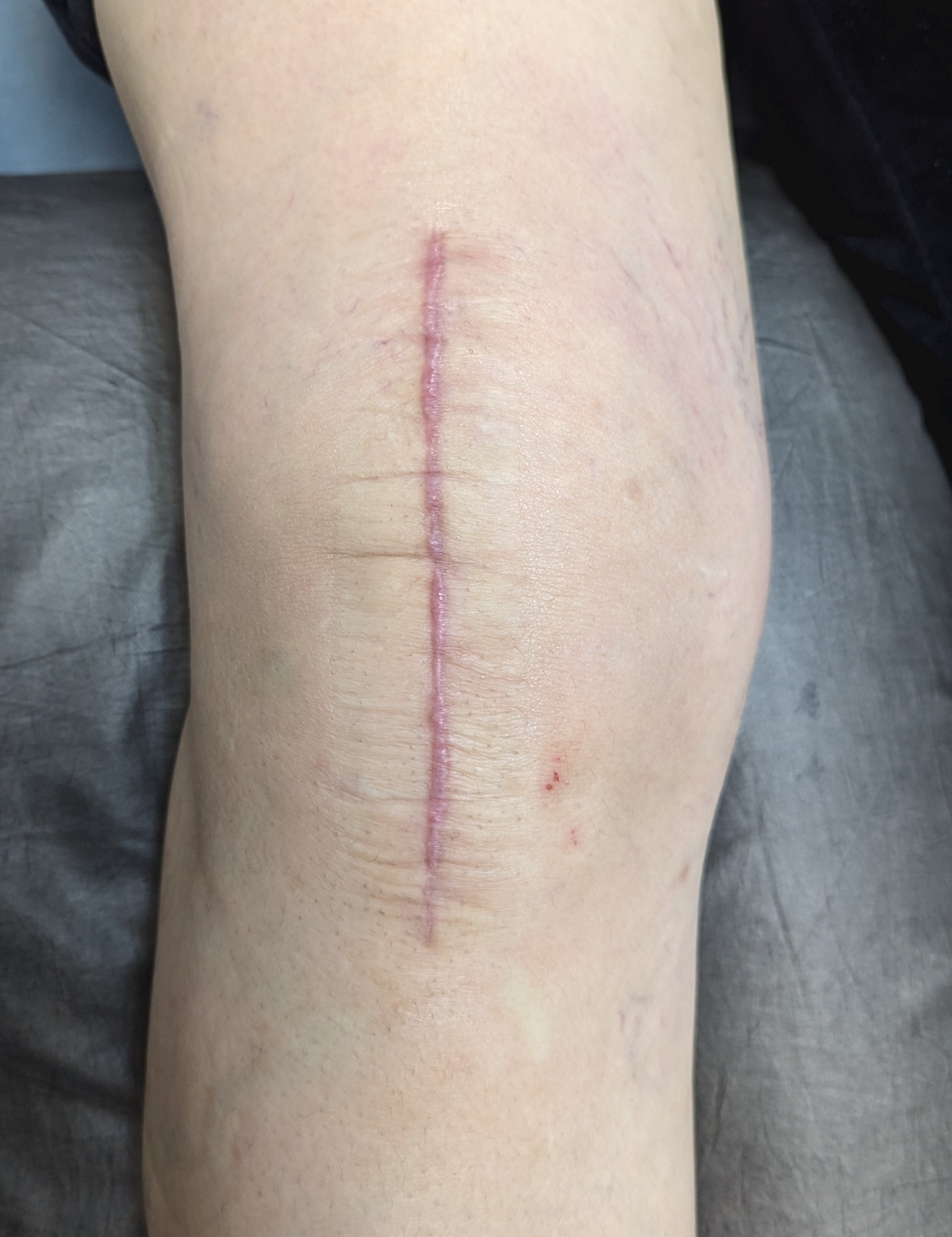 本頁圖片/檔案 - 術後約6周恢復良好的傷口